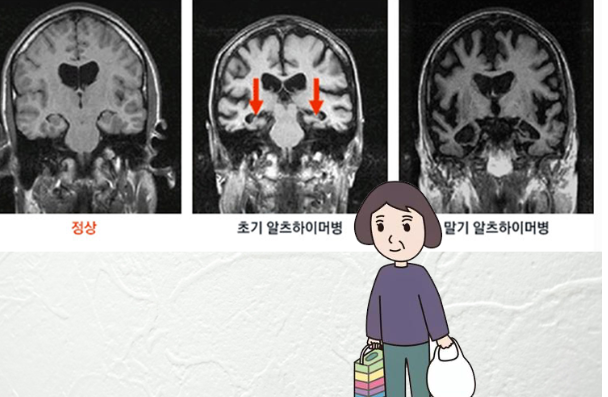 보건소 치매검사 무료로 받는 방법과 비용문제 자세하게 알아보기 2024년 최신버전